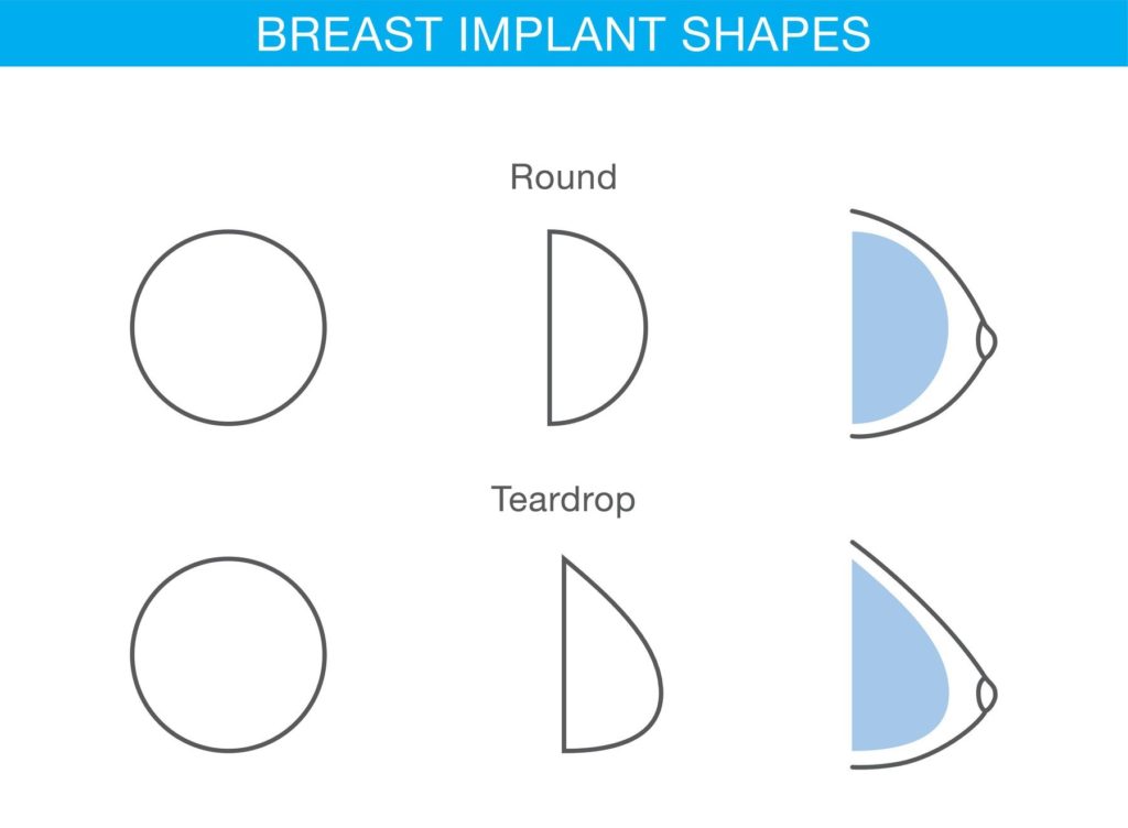 Difference of breast implant round and teardrop shapes in cosmetic surgery., Image: 313066973, License: Royalty-free, Restrictions: , Model Release: no, Credit line: Profimedia, Alamy