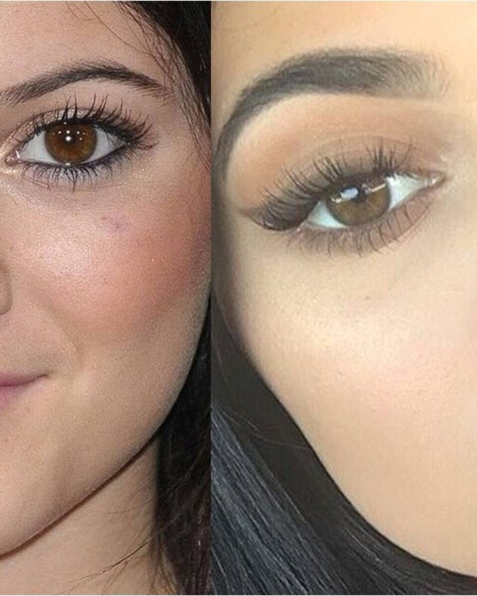 Dermalni fileri: brzo i jednostavno do punih usana