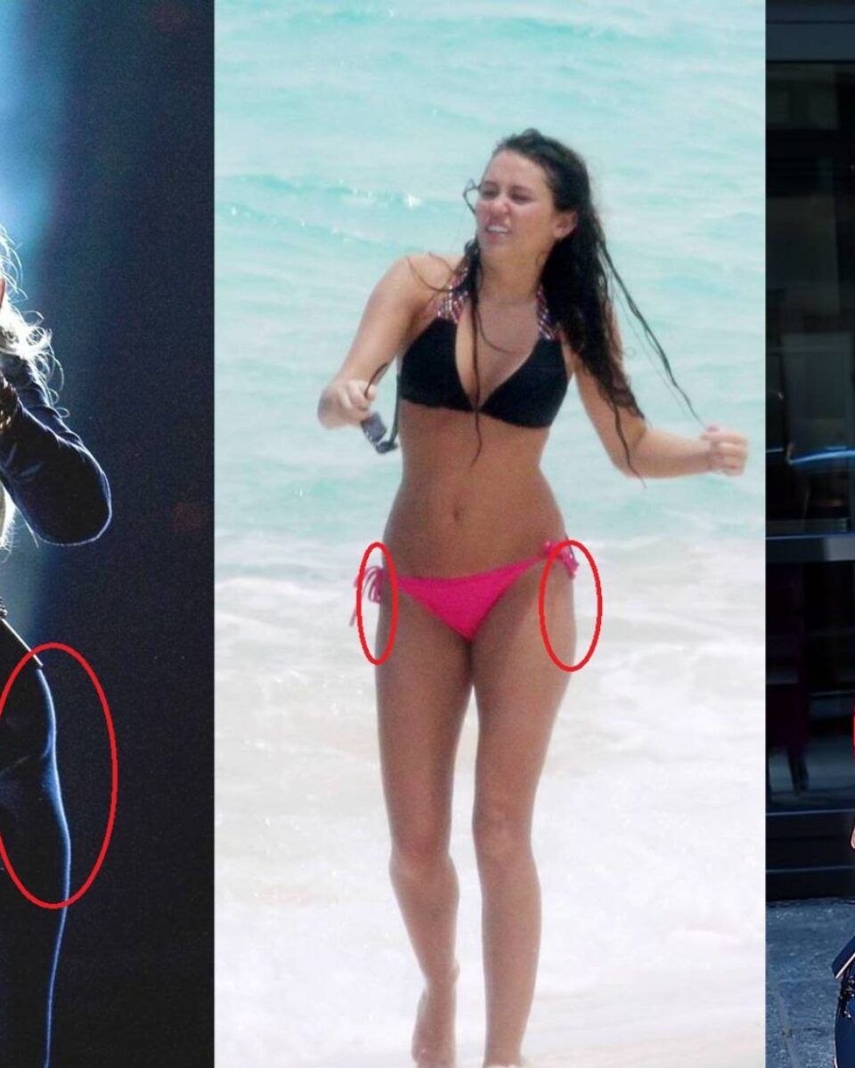 Izražene udubine na bokovima – postoji li rješenje?