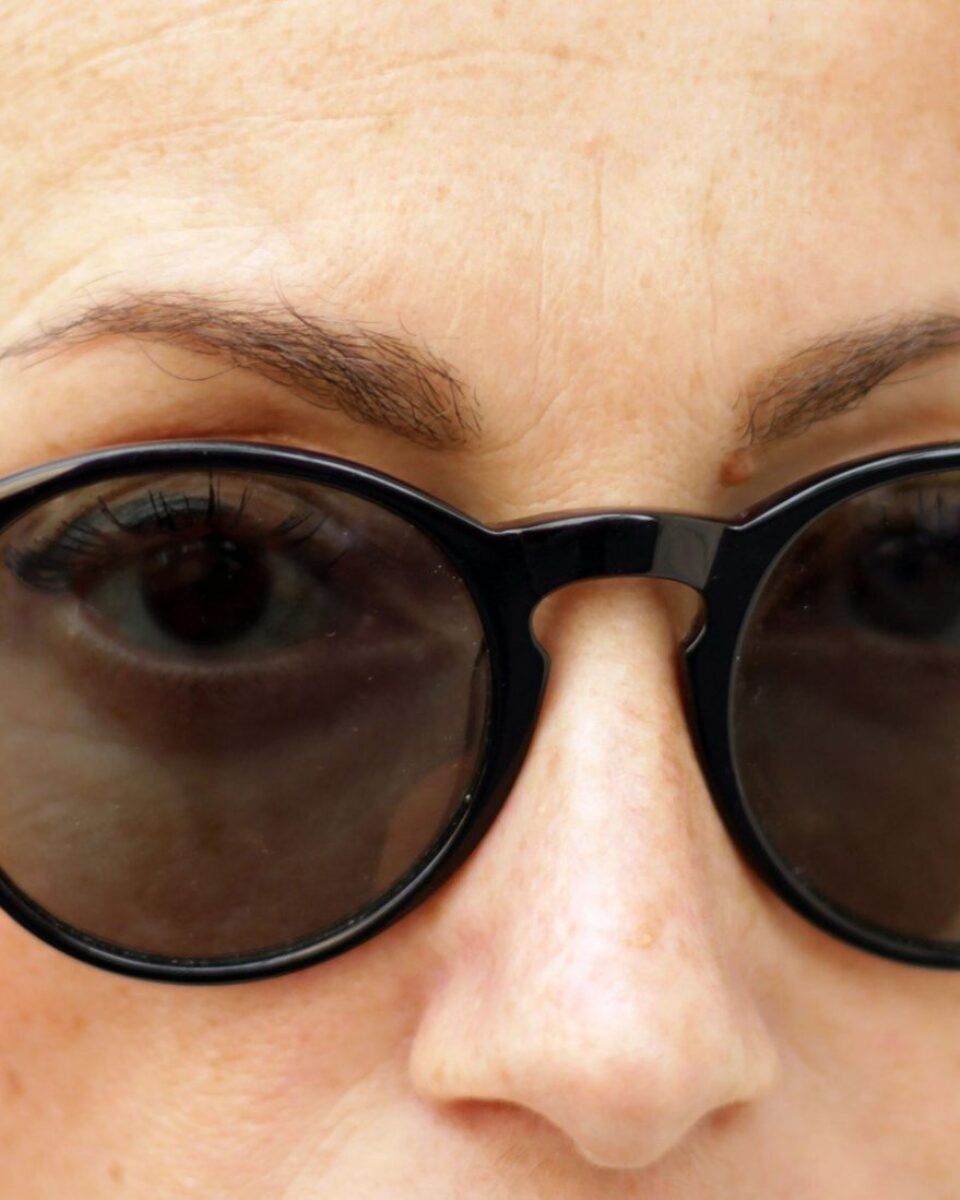 Što izbjegavati neposredno nakon tretmana botoxom?