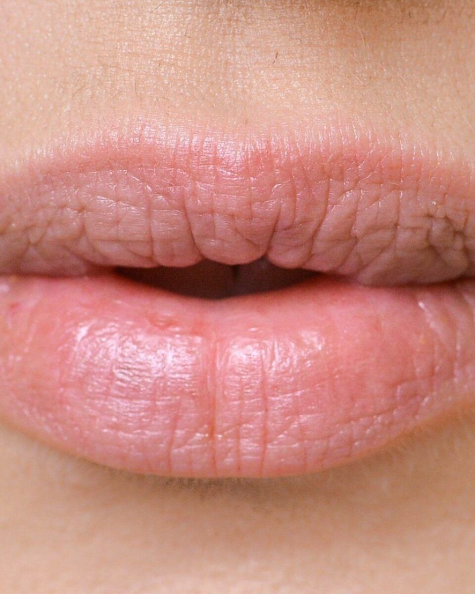 “Prije i poslije”: Pogledajte fotografije povećanja usana vrhunskih hrvatskih liječnika