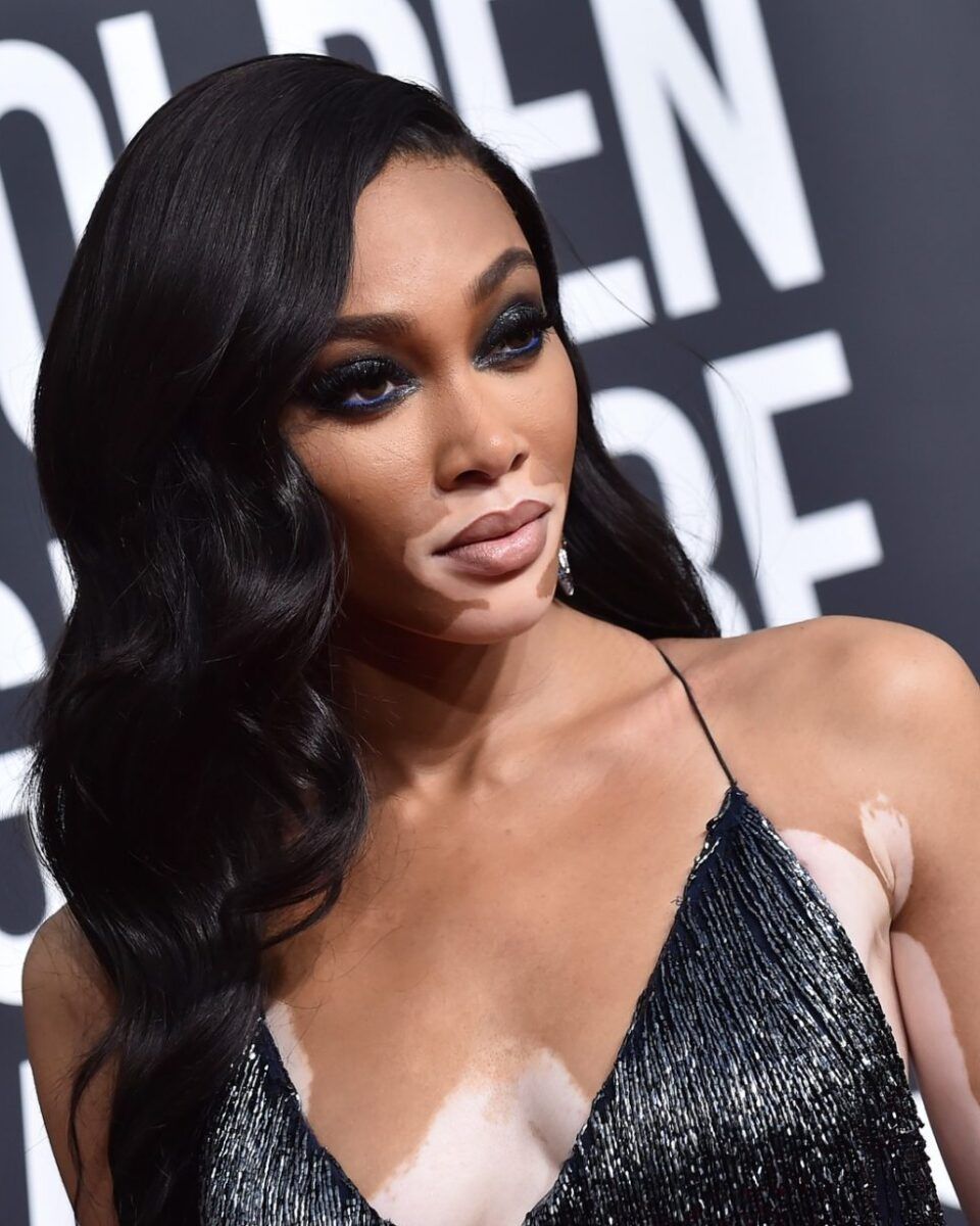 Inovativna formula: krema koja ublažava vitiligo u svim fazama