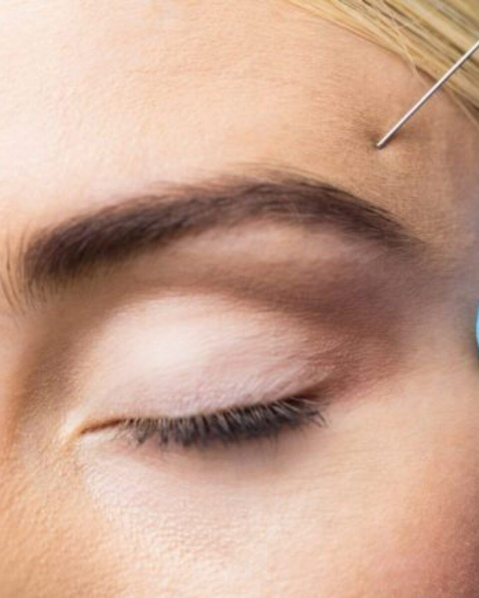 “Do and don’t” – što Vogue kaže o botoxu?