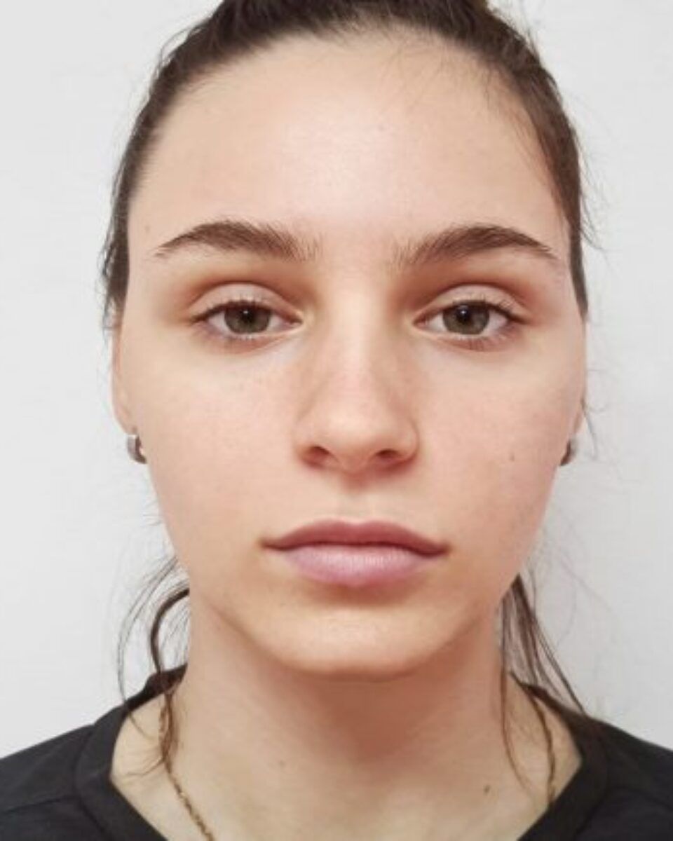 Povećanje usana s vrlo prirodnim efektom – donosimo rezultate