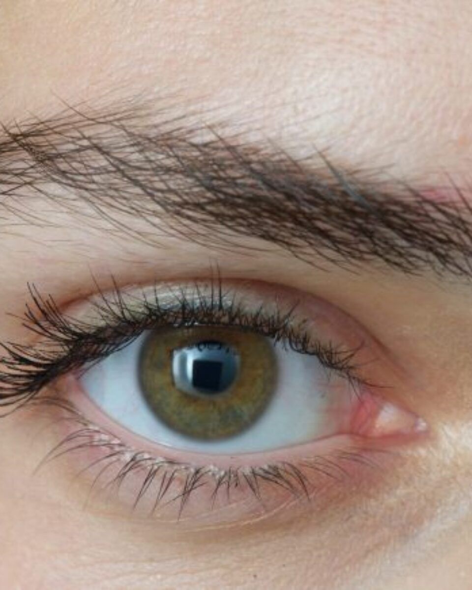 Može li se očni kapak podignuti botoxom?