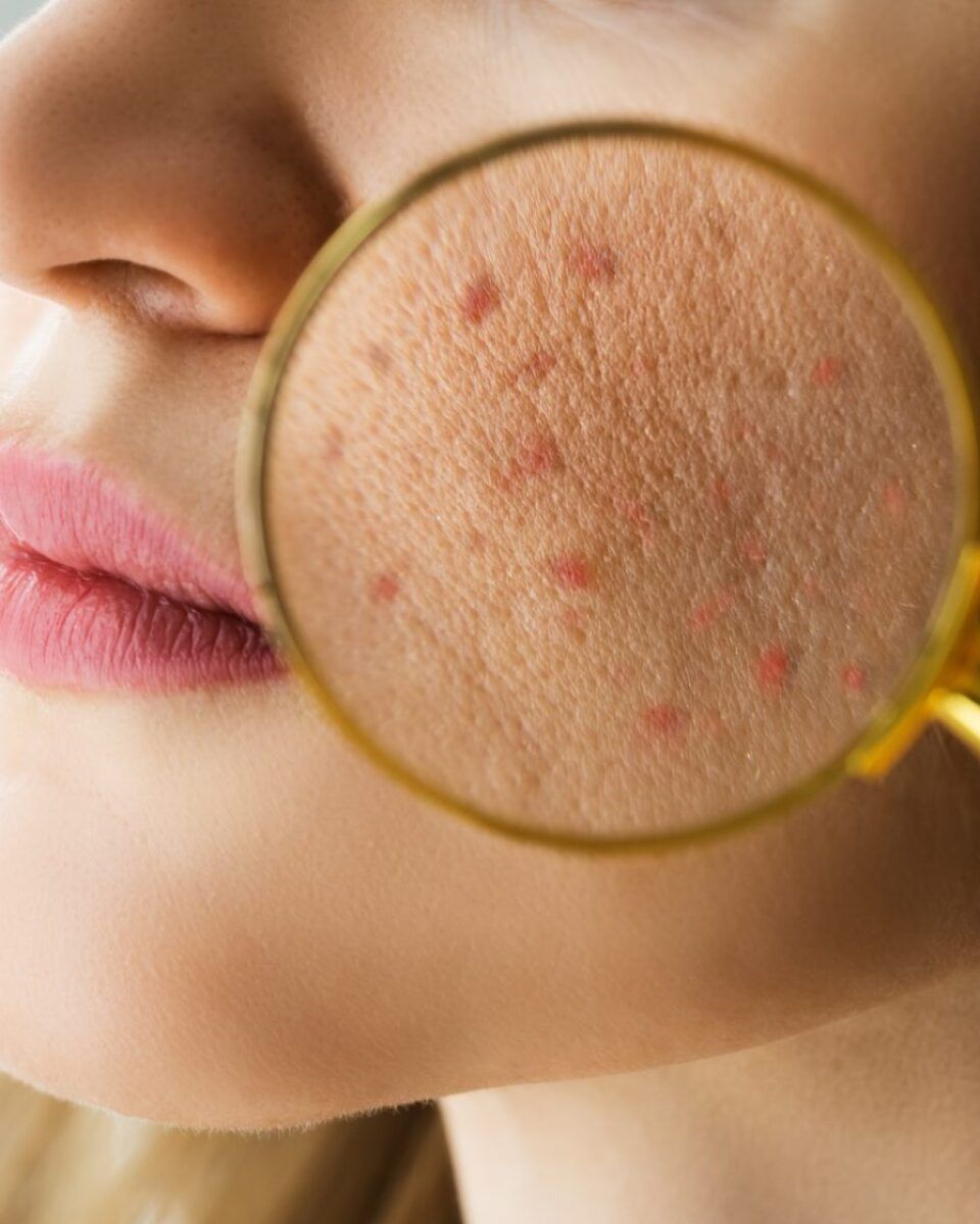 Akne imaju i odrasli