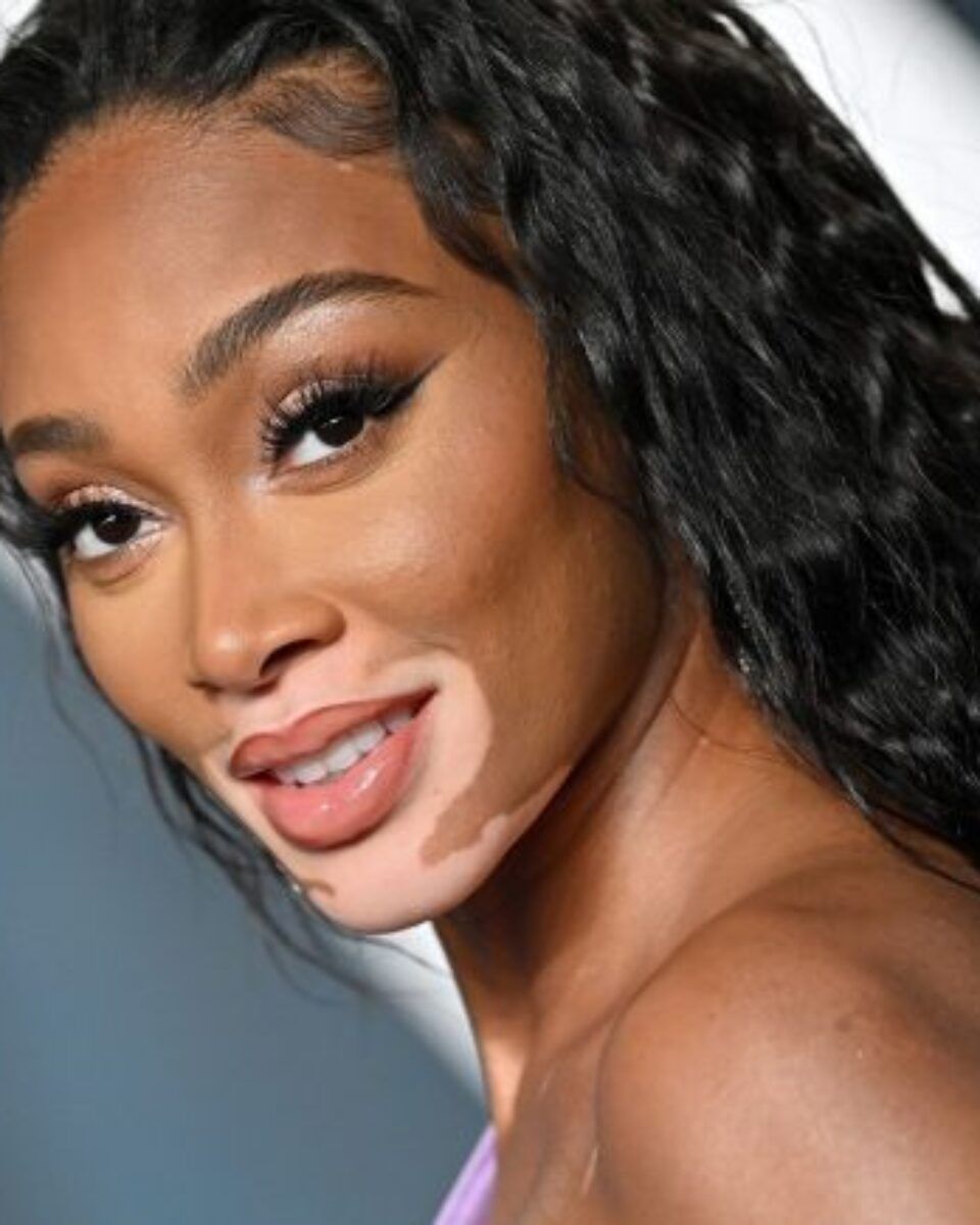 Vitiligo možete dobiti u svakoj životnoj dobi