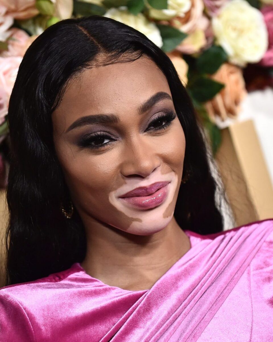 U povodu Svjetskog dana vitiliga, dermatolozi donose najbolju formulu za tretiranje depigmentacija