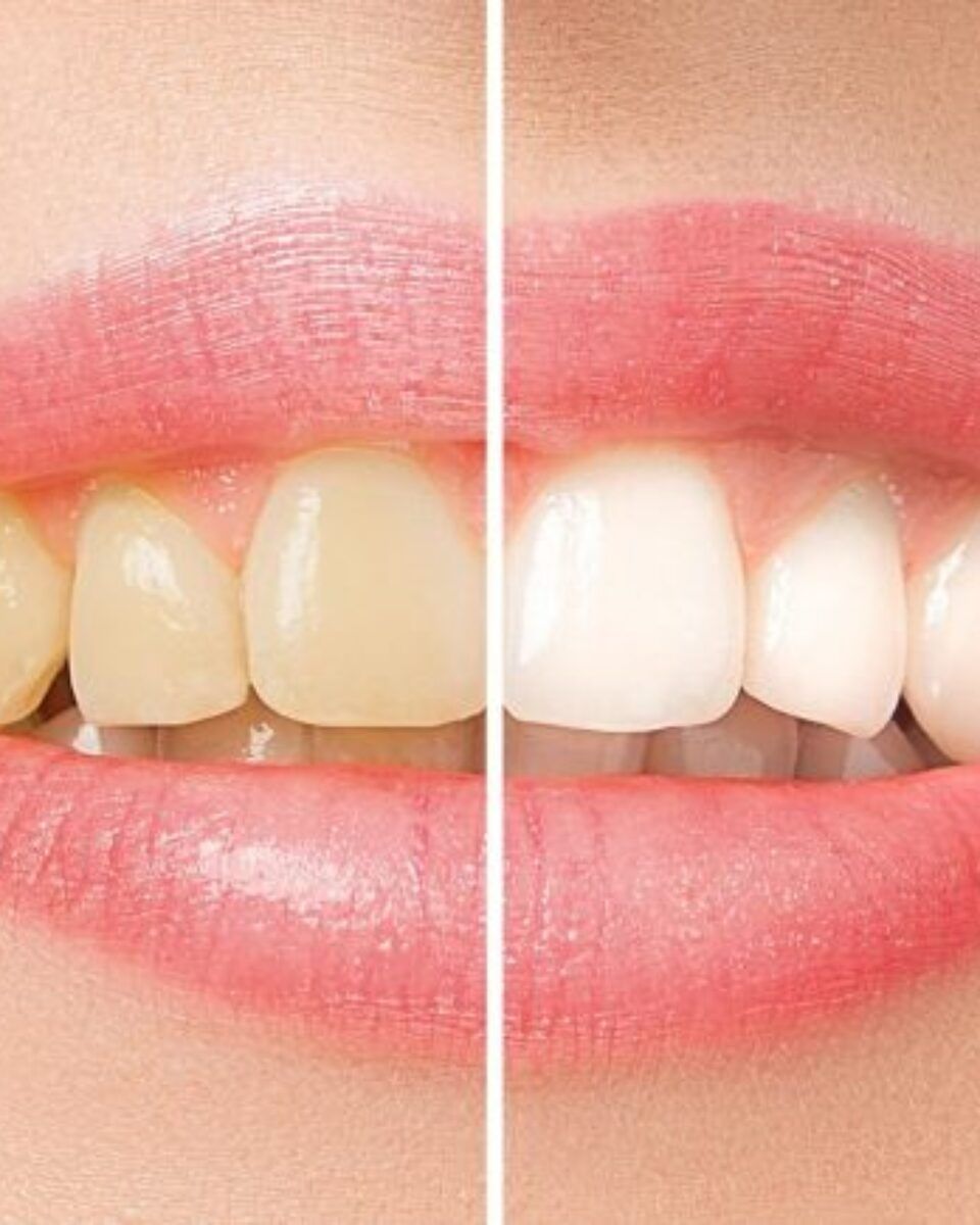 Donosimo cijene izbjeljivanja i pjeskarenja zubi nakon ljeta