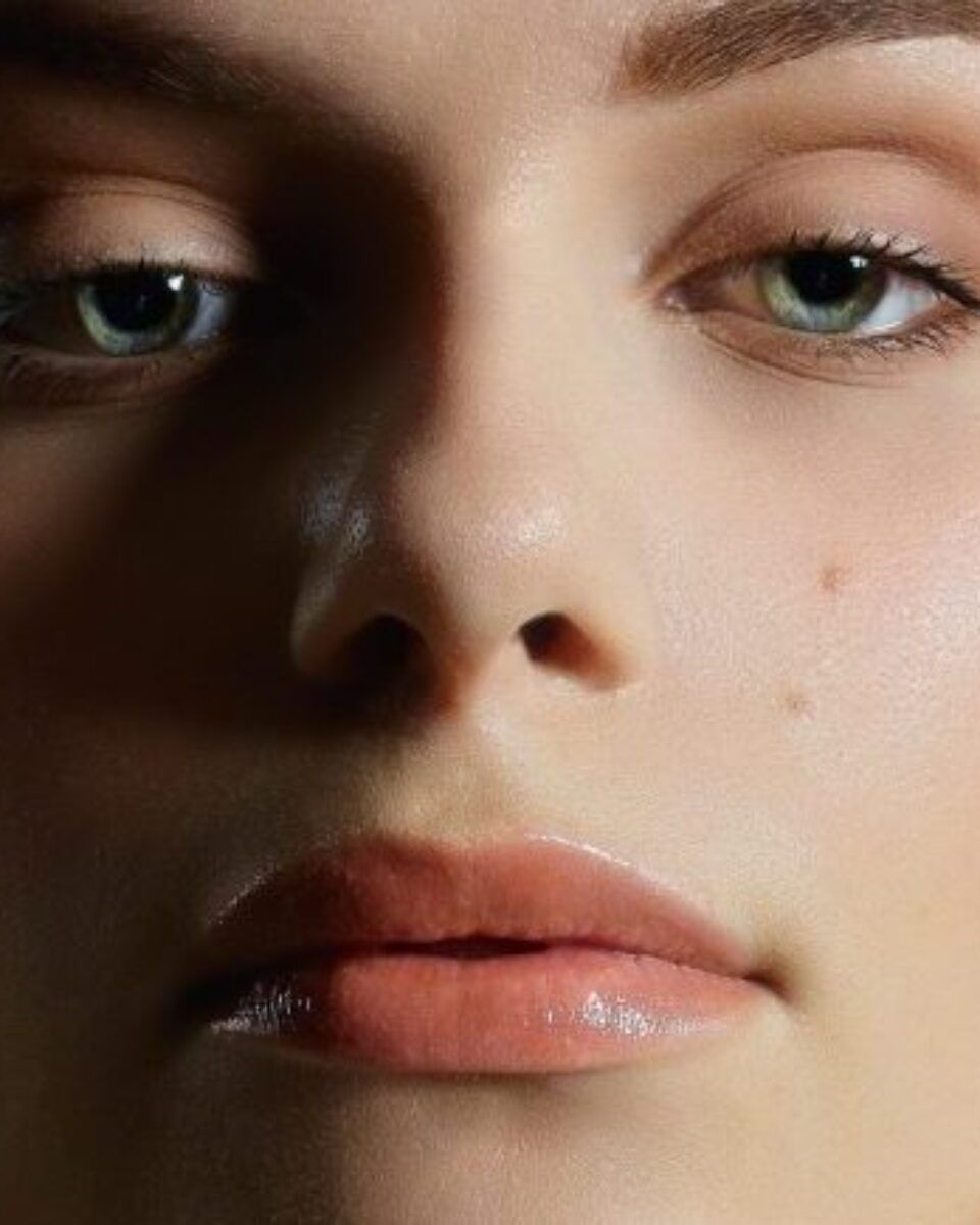Što kada se akne zadrže i nakon posjeta dermatologu i promjene skincare rutine?