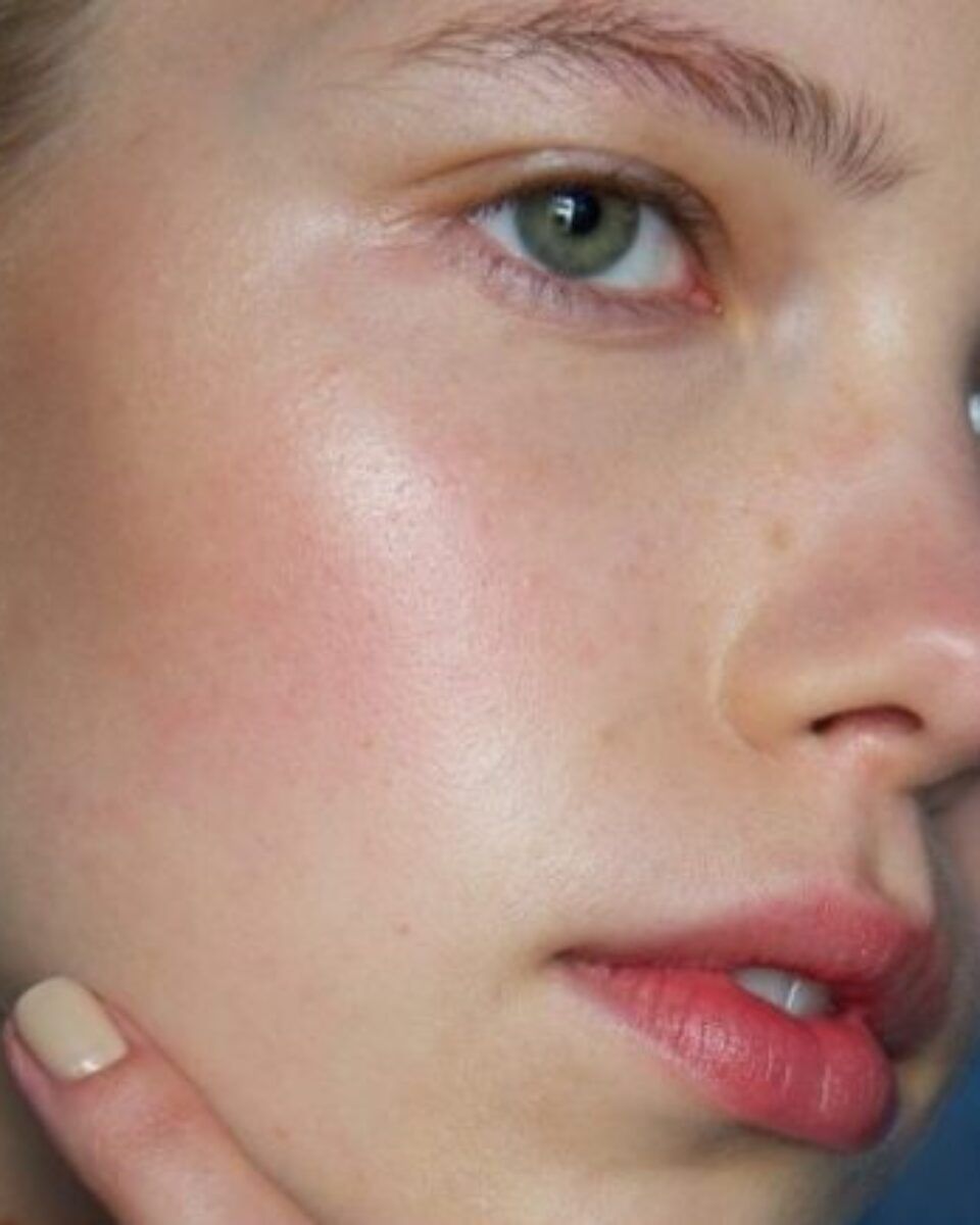 Koliko prosječno traje liječenje akni i kako osigurati da se one ne vrate?