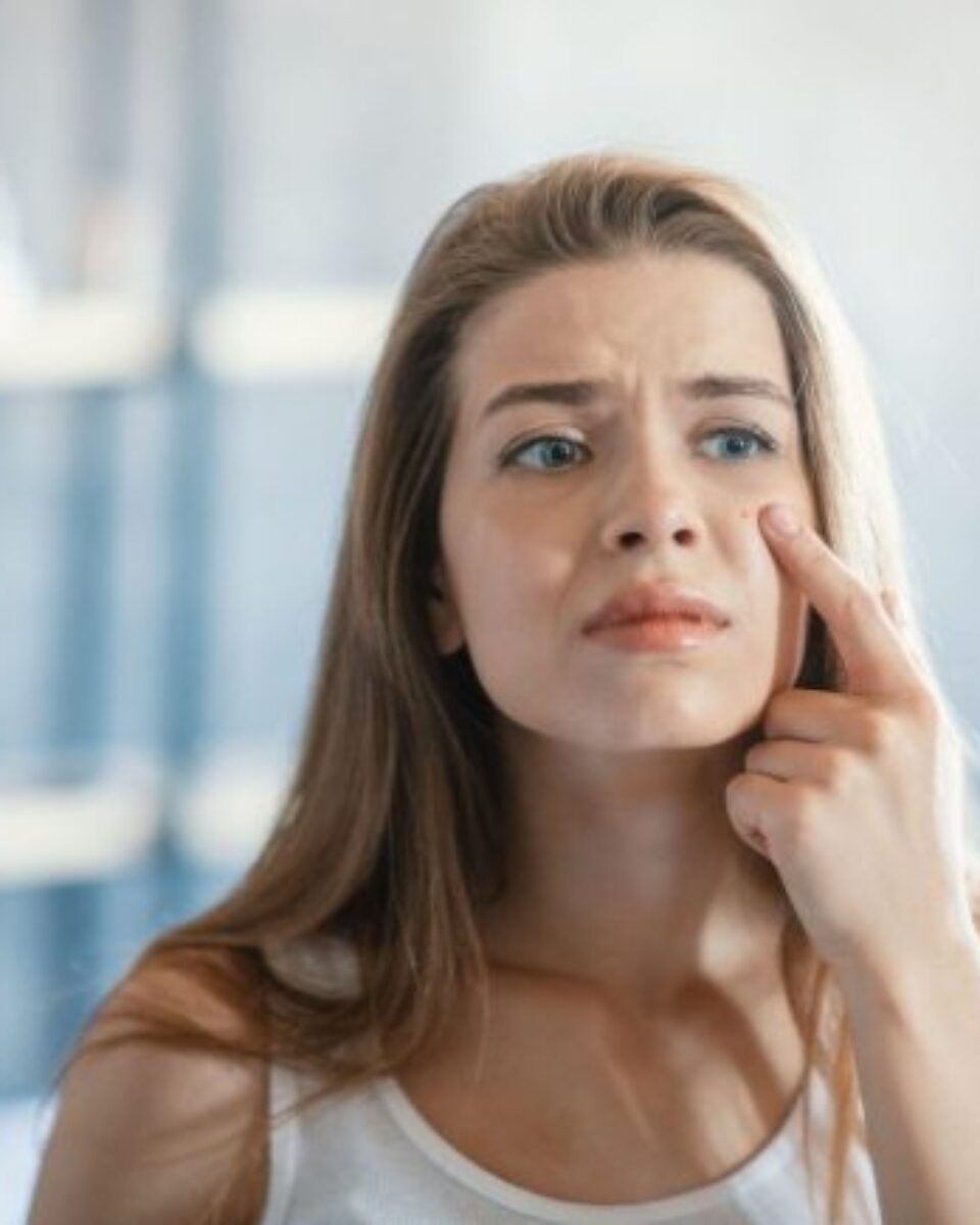 Akne povezane s hormonima – kako i zašto nastaju i možemo li ih se riješiti