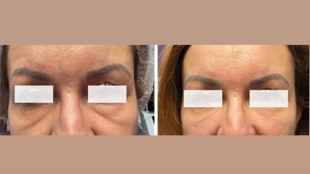 Infini Premium Meso Eyeboosteri