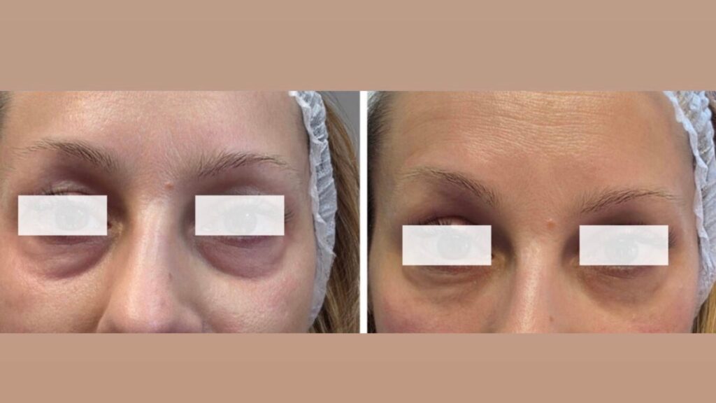 Infini Premium eyeboosteri