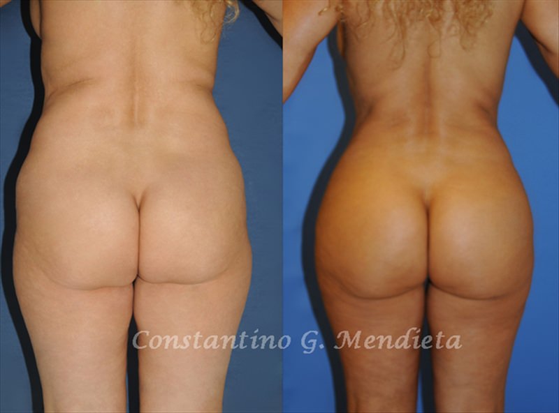 Prije i poslije. Izvor foto: iz arhive dr. Mendiete, buttsbymendieta.com