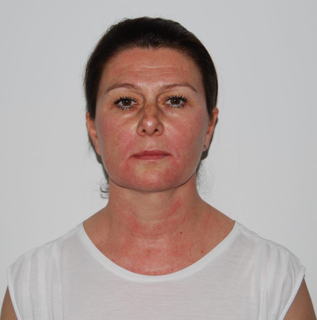 Neposredno nakon tretmana botoxom i filerima