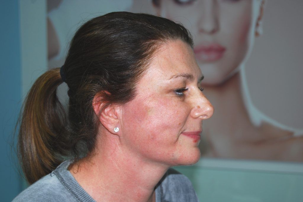 Neposredno nakon tretmana Silhouette Soft koncima