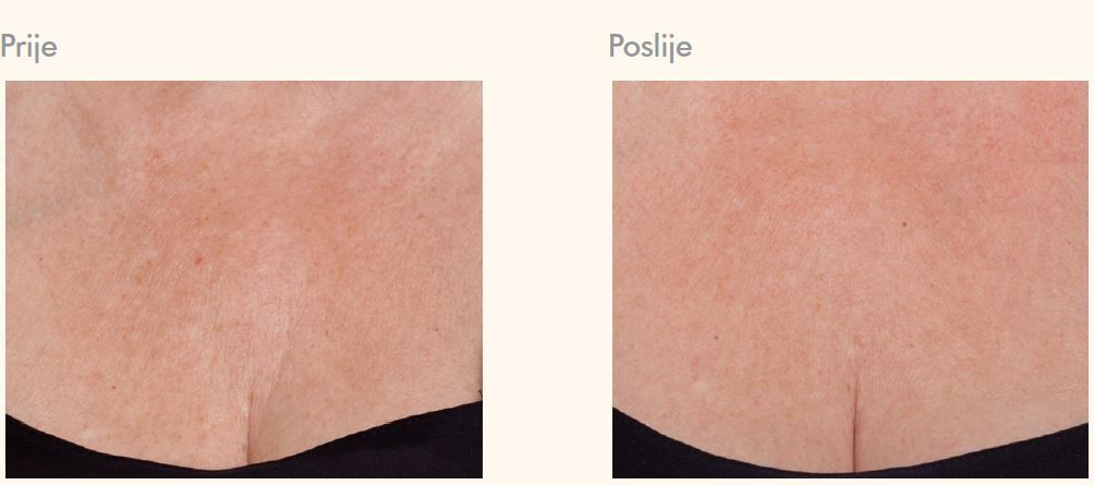 dekolte prije i poslije