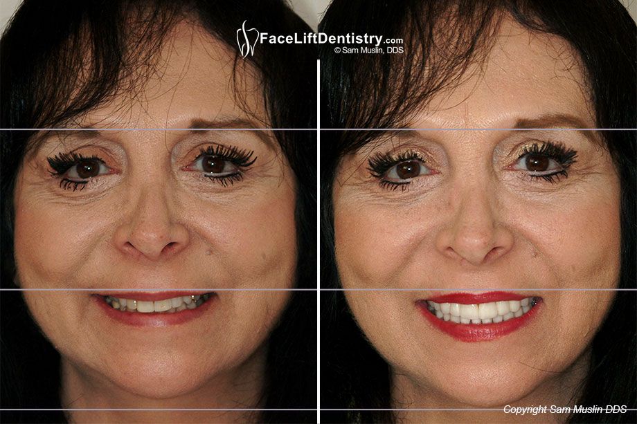 dental-facelift