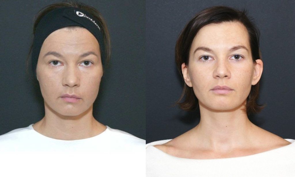 Prije tretmana i poslije 3 tjedna