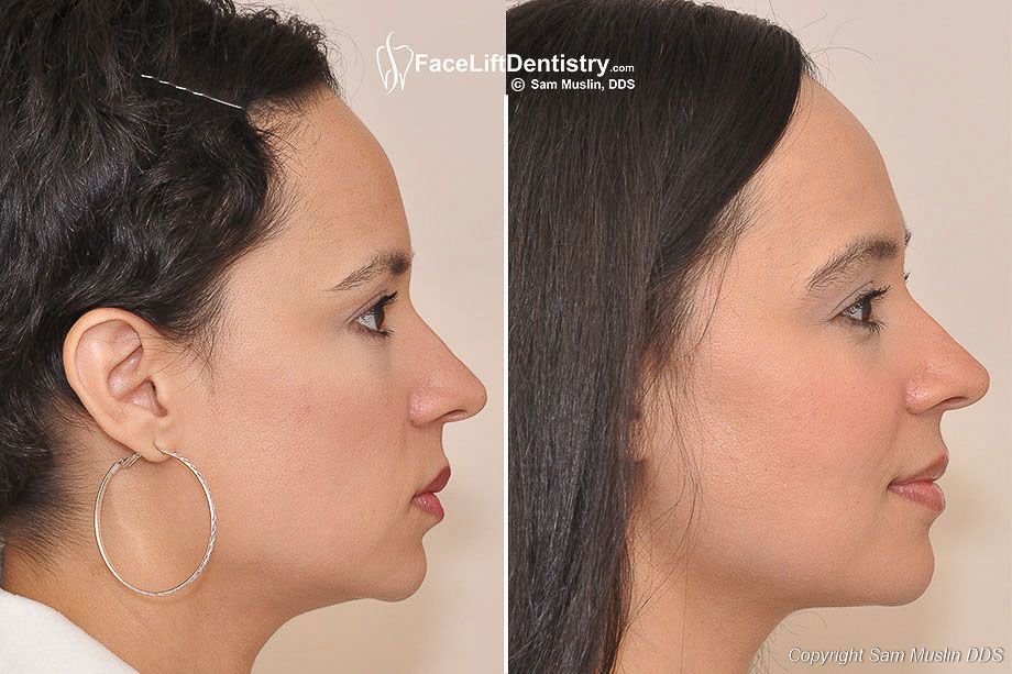 Iz arhive dr. S. Muslina. Izvor: faceliftdentistry.com