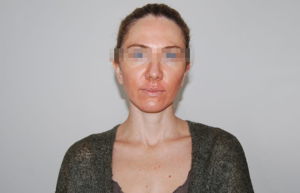 Nakon nanošenja kreme