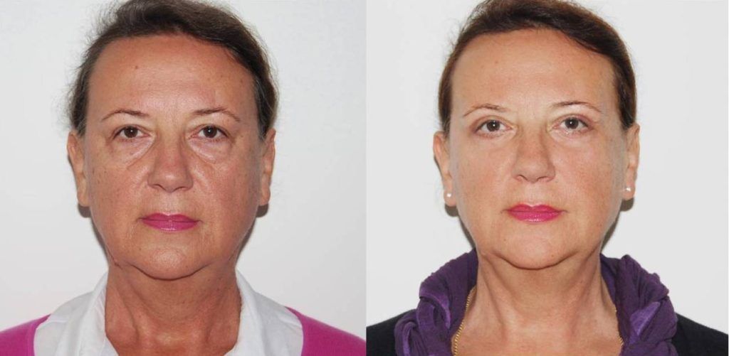 Prije zahvata i poslije zahvata (nakon 6 tjedana)