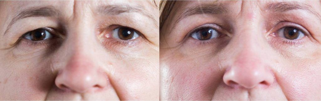 Kapci prije i poslije