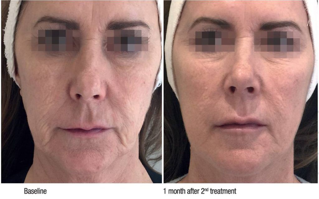 Prije i poslije. Izvor: službena fotografija