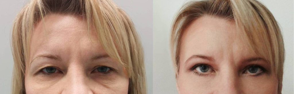 Prije i poslije (iz arhive dr. M. Miletića)