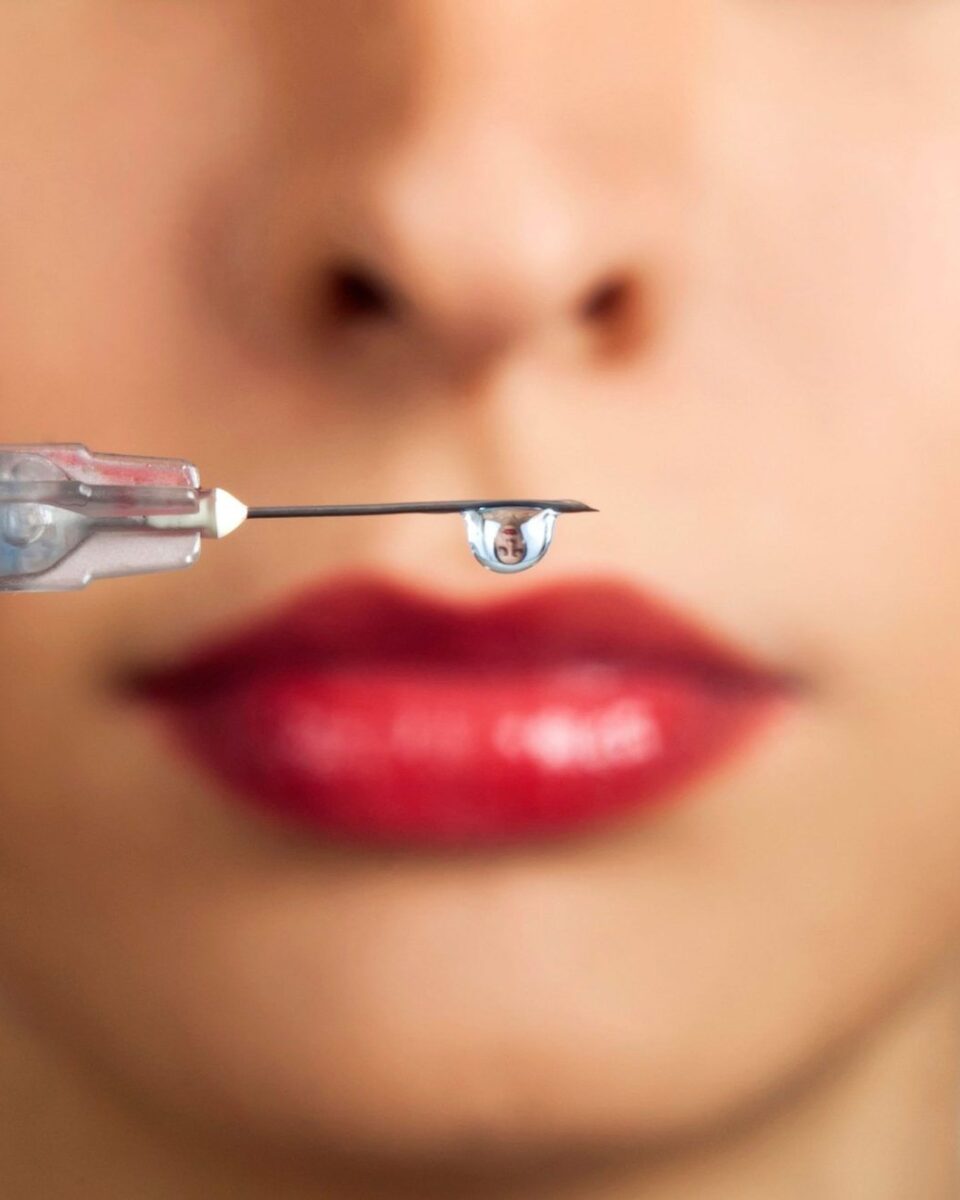 Fileri ili botox: kad je pravi trenutak za jedno, kad za drugo? A kada za oboje!
