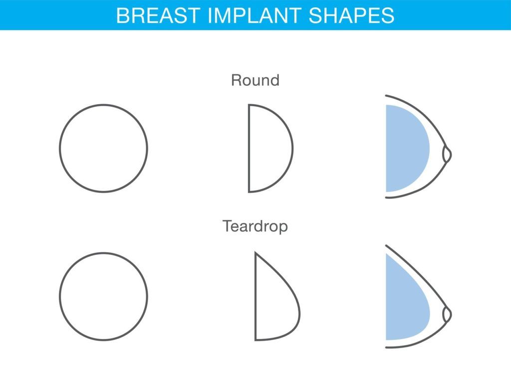 Difference of breast implant round and teardrop shapes in cosmetic surgery., Image: 313066973, License: Royalty-free, Restrictions: , Model Release: no, Credit line: Profimedia, Alamy