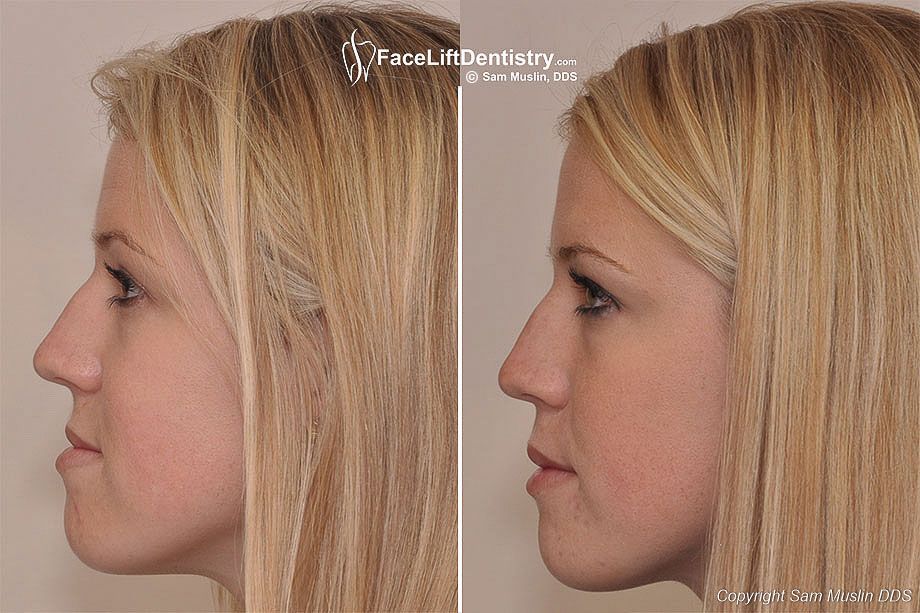 under-bite-corrected-profile