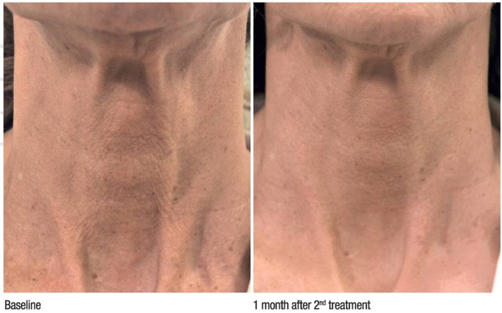 Prije i poslije. Izvor: službena fotografija