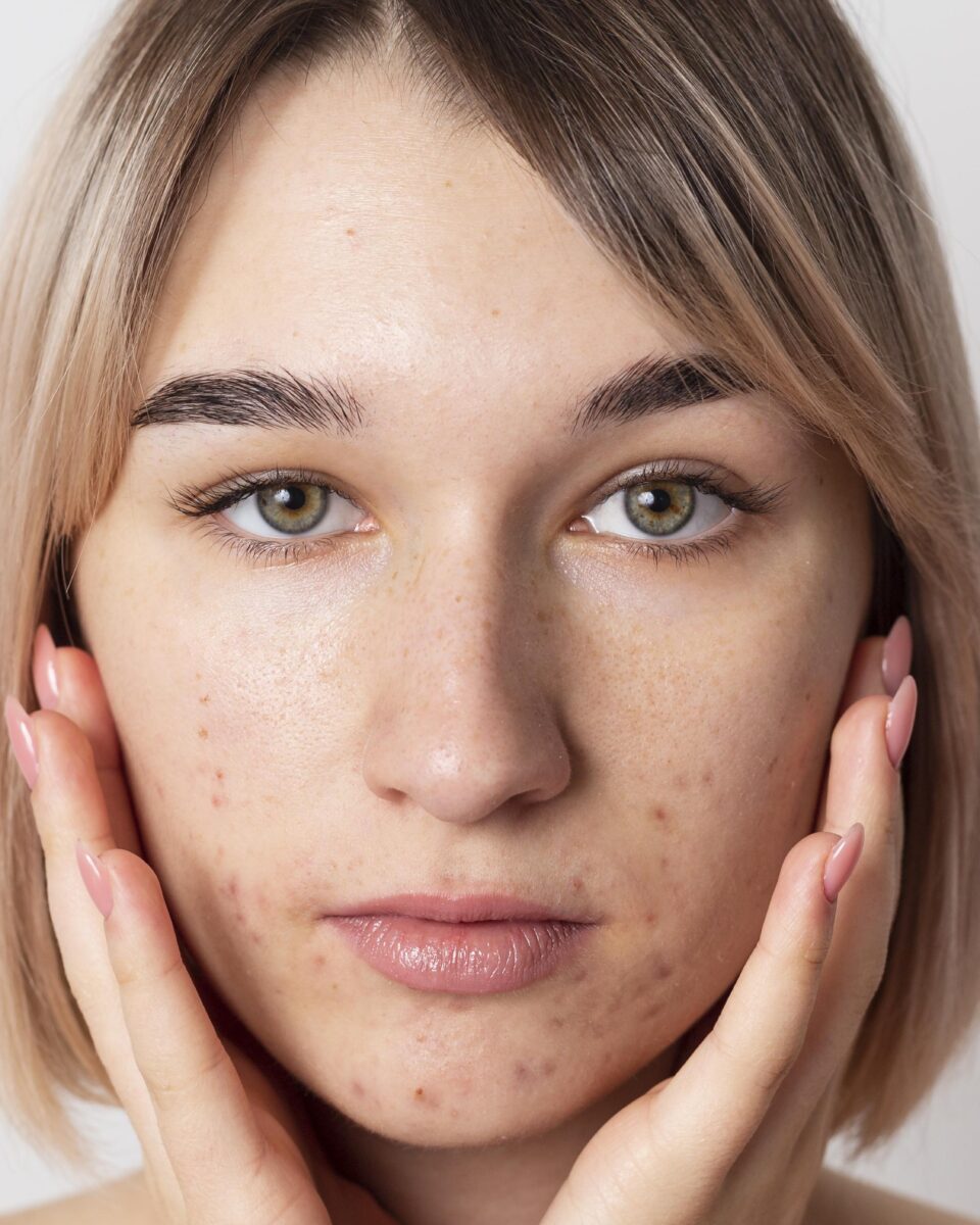 Slučaj akne: zašto je dermatološku terapiju nužno upotpuniti liječenjem crijevnog mikrobioma?