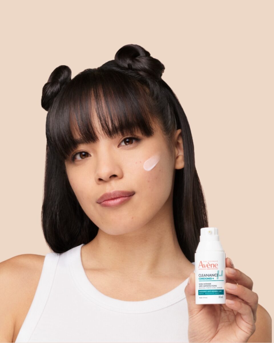 Ova formula u samo 5 sati sprječava razvoj akni!