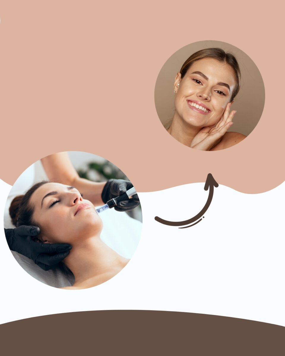 Microneedling za obnovu kože po posebnoj cijeni!  