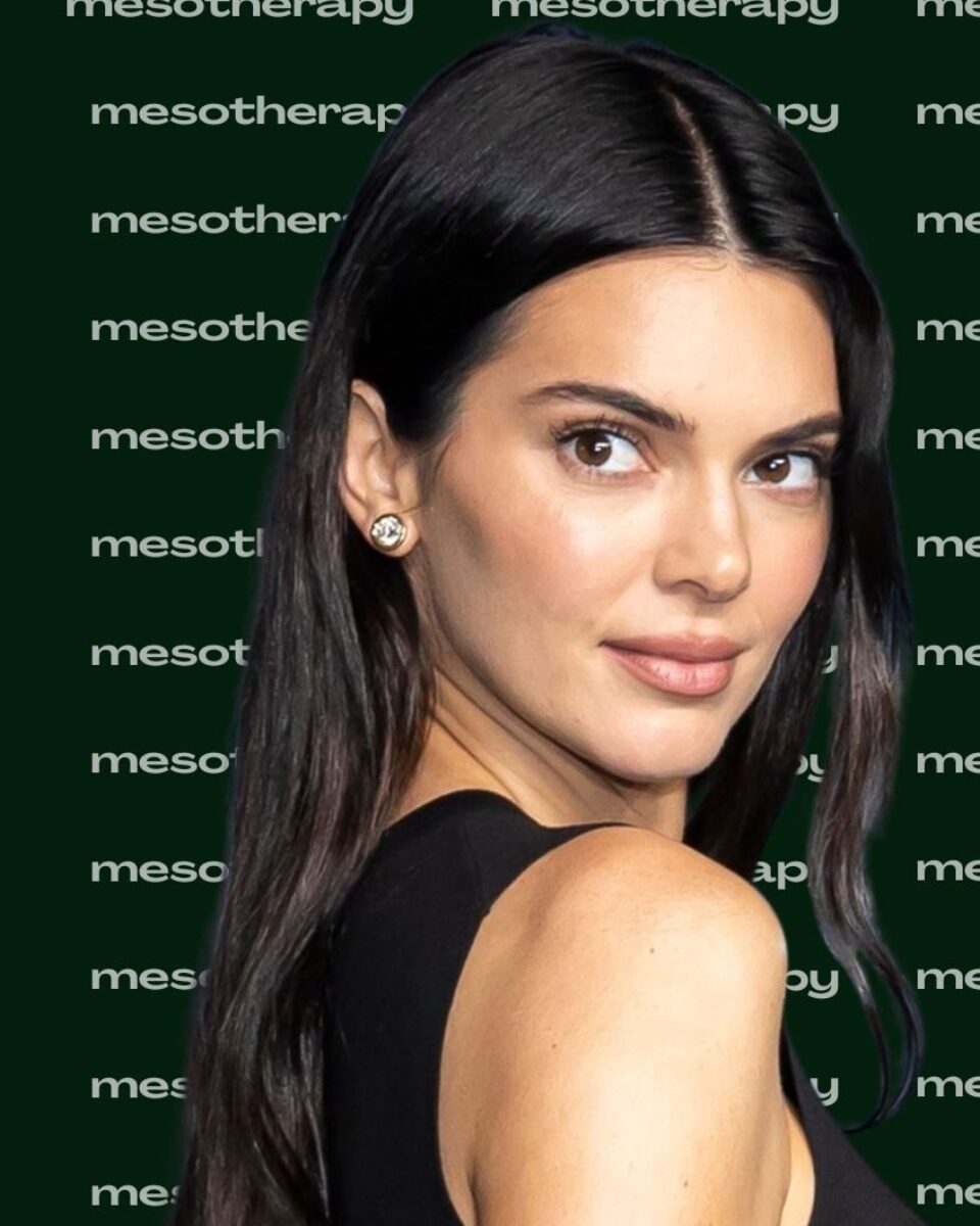 Mezoterapija i zašto je od nje lice najbolje?