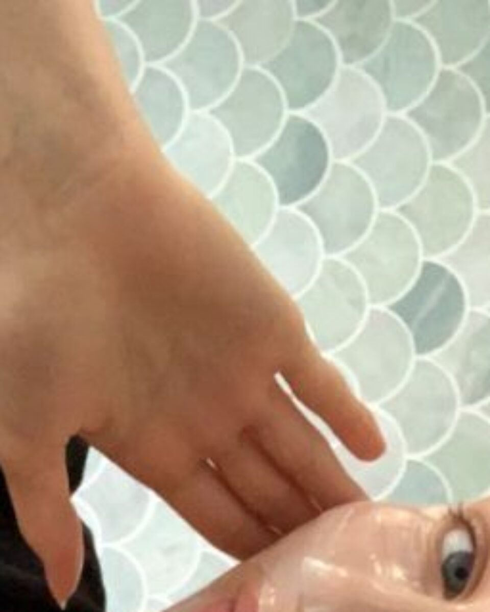 Akne, pad imuniteta i stres: zašto se akne pojavljuju baš onda kad nam to najmanje treba?