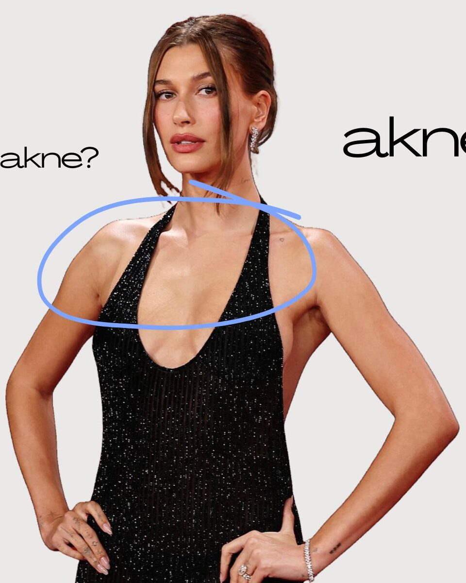 Akne na dekolteu: zašto nastaju i kako ih tretirati?