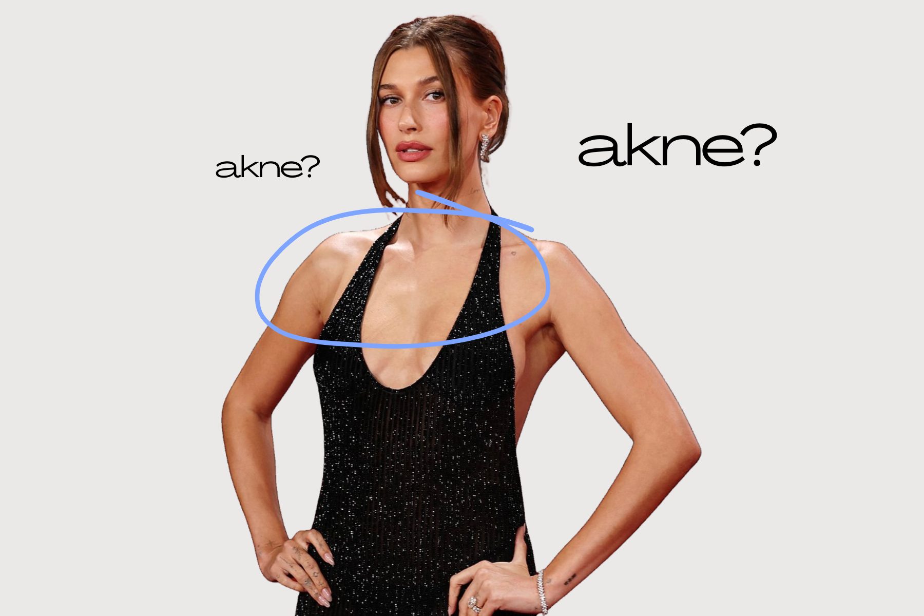 Akne na dekolteu: zašto nastaju i kako ih tretirati?