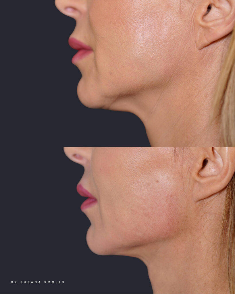 dr suzana smoljo pomlađivanje