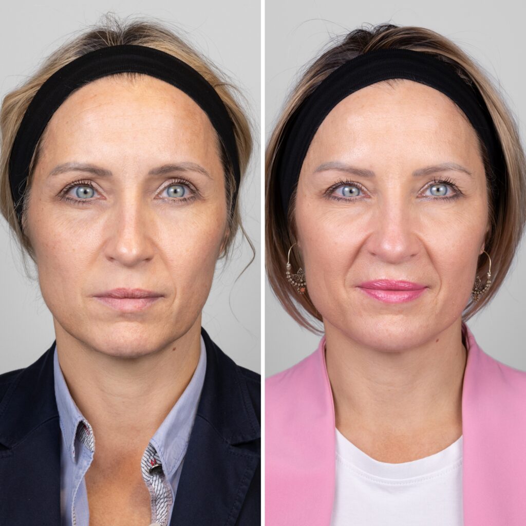 Pomlađivanje lica cvjelovit pristup