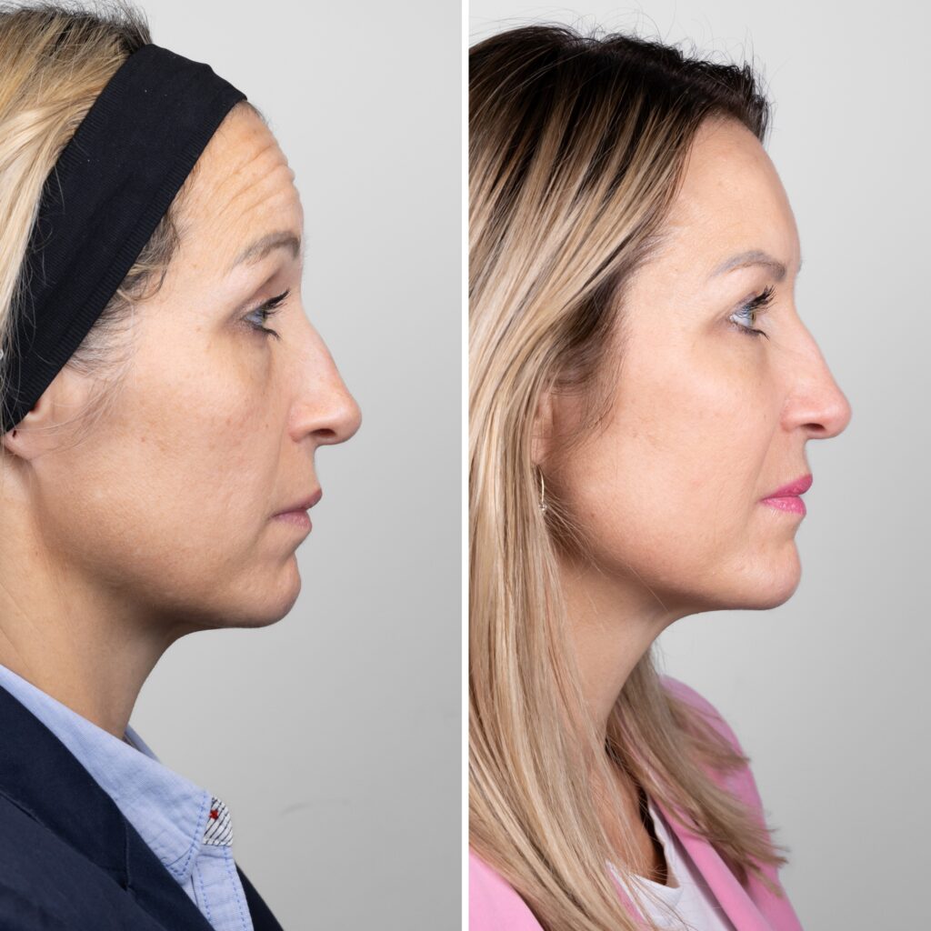 dr suzana smoljo pomlađivanje