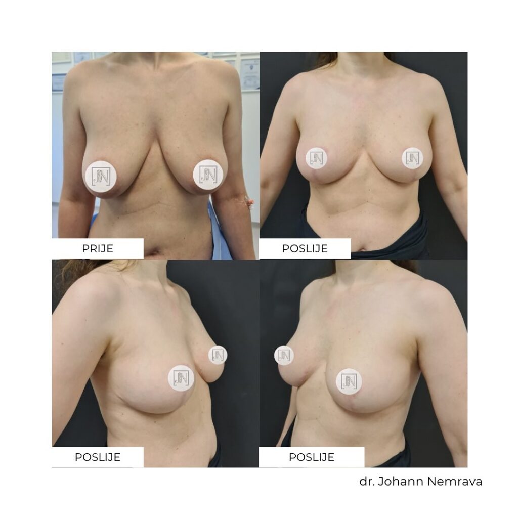 Smanjenje i podizanje grudi bez umetanja implantata