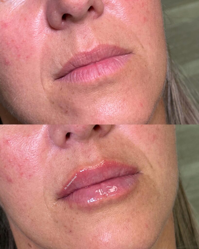 dr. suzana smoljo povećanje usana