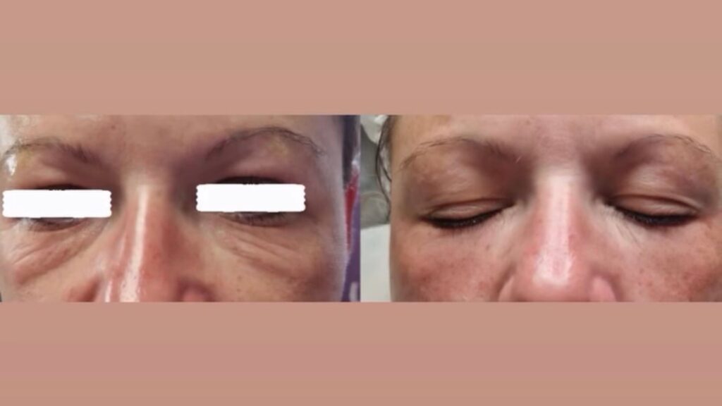 Kako ukloniti podočnjake i pomladiti područje oko očiju