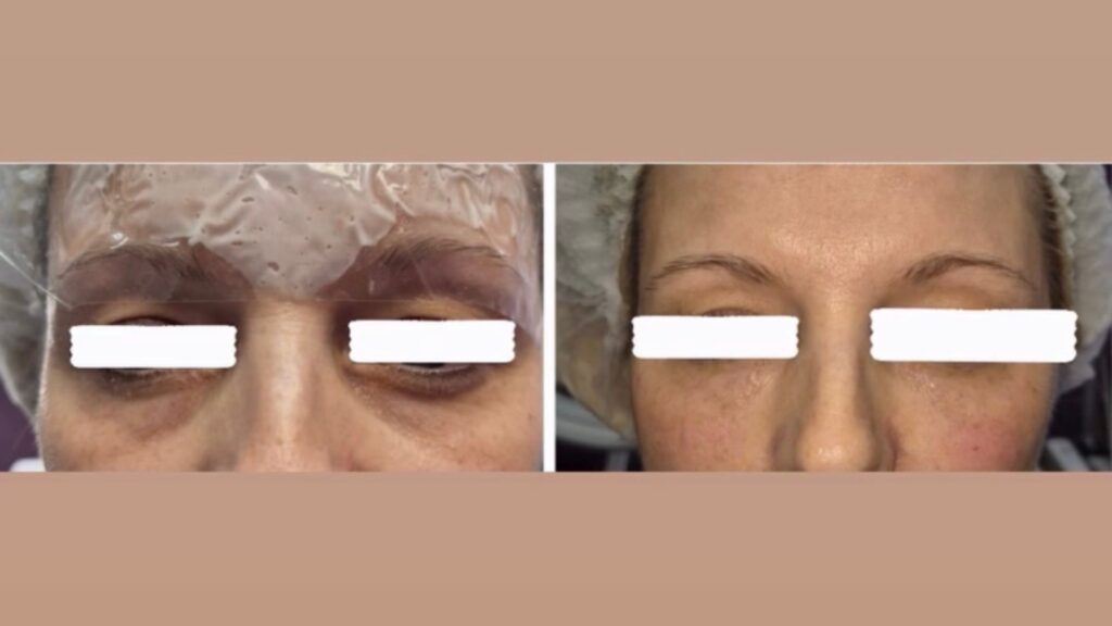 Eyebooster za atrofiju, finu naboranost i podočnjake