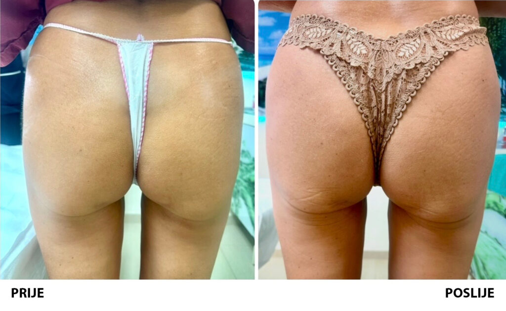 Podizanje stražnjice aptos nitima prije i poslije dr. vivain jurkovic