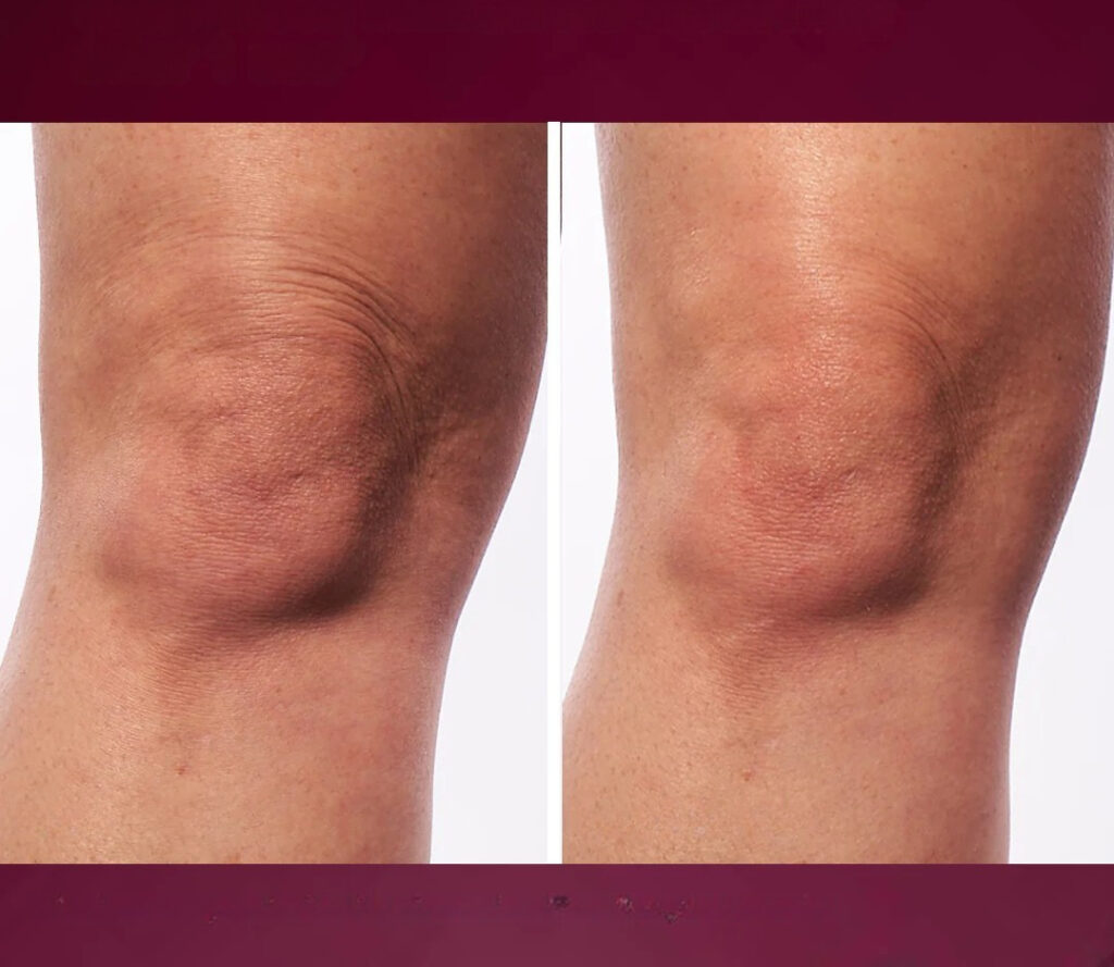 Dynamic Skin Sculptor za učvršćivanje kože tijela prije i poslije